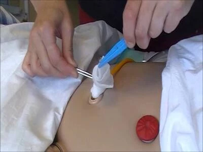 Suprapubische sonde